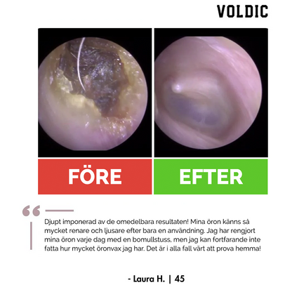 Voldic™ Elektrisk Öronvaxborttagningskit